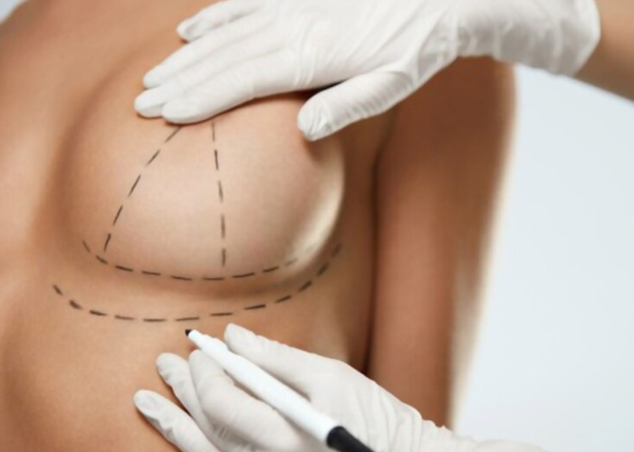 do you need implants with breast lift